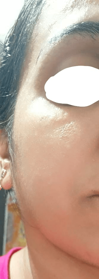 After Treatment
