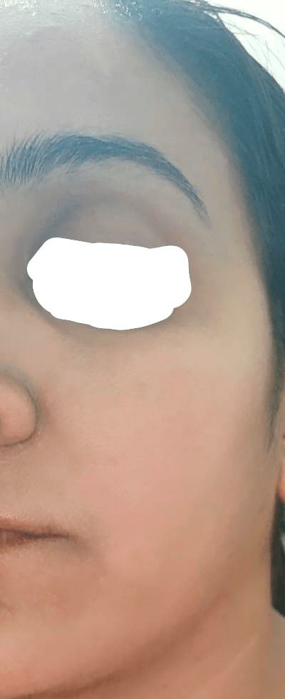 After Treatment