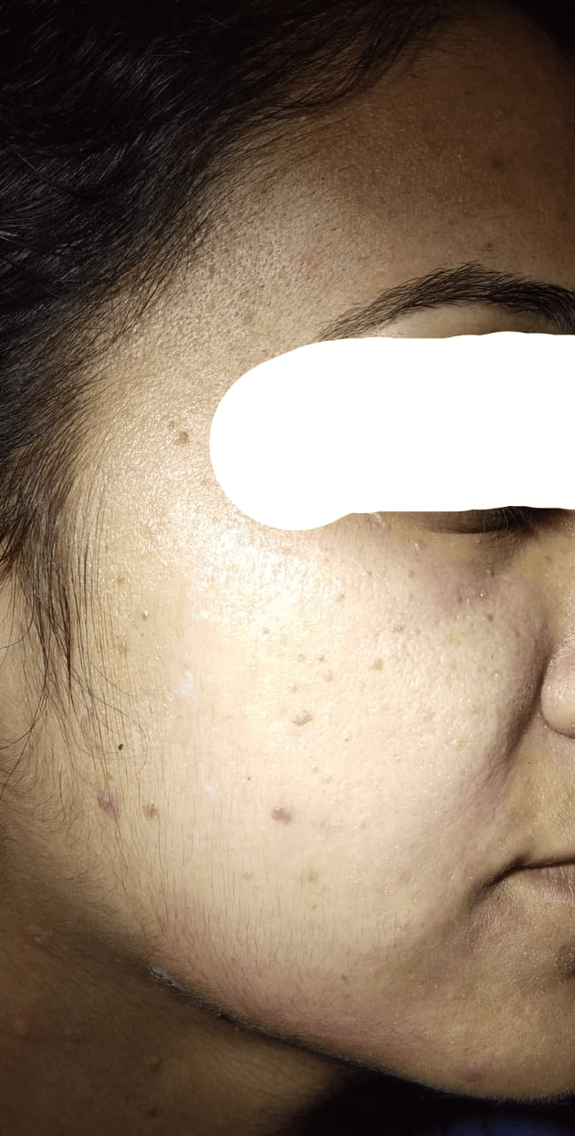 Before Treatment