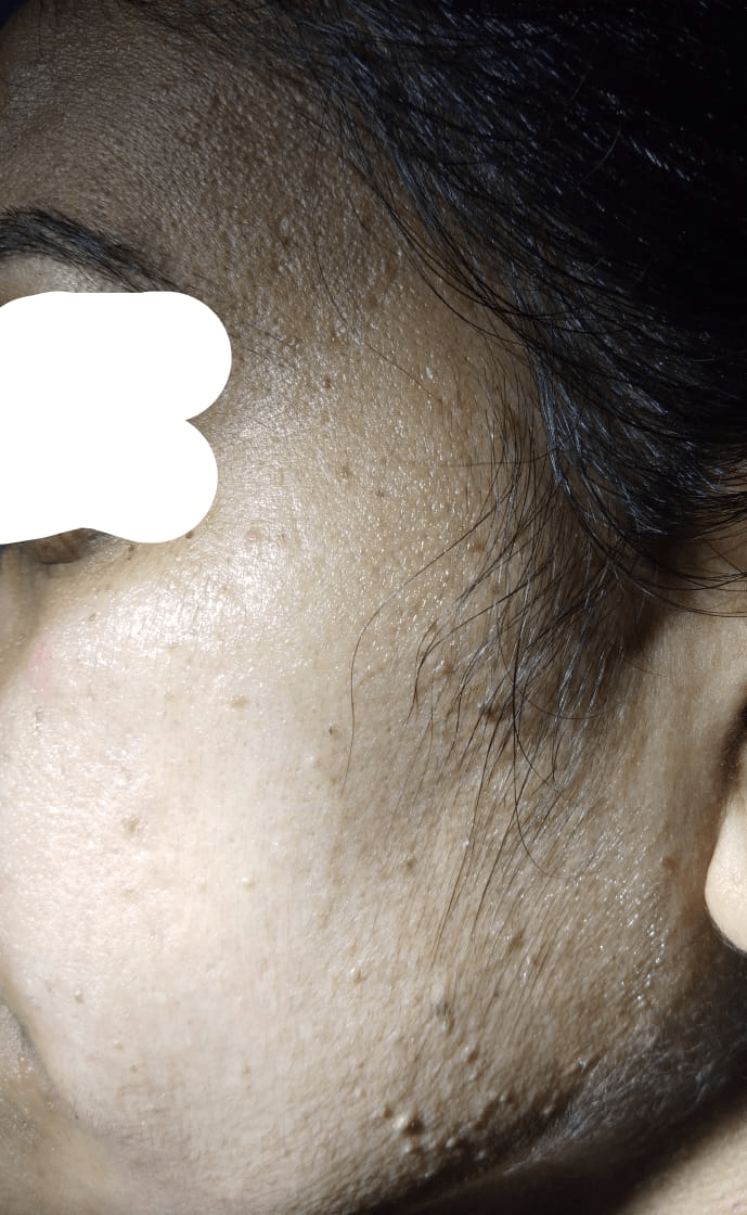 Before Treatment